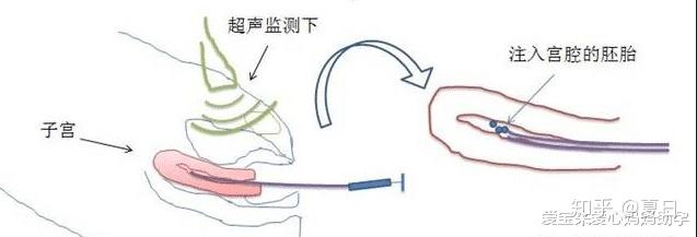 HIV患者进行三代供卵代生地址前的治疗与检测